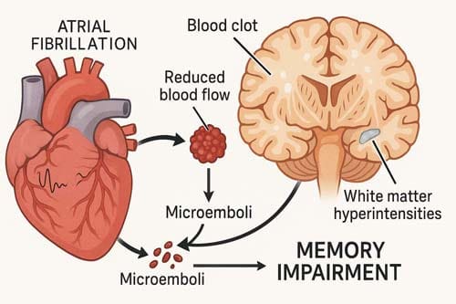 Hidden Link: How AFib Directly Affects Your Memory Loss Risk 4 Afib And Memory