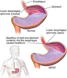 Gerd A Gastrointestinal Diseases