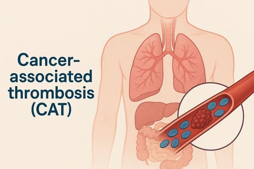 Cancer-Associated Thrombosis