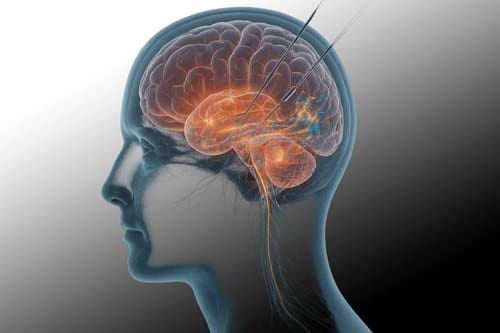 Deep Brain Stimulation